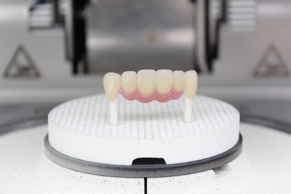 The Longevity Of Dental Bridges: What You Should Know