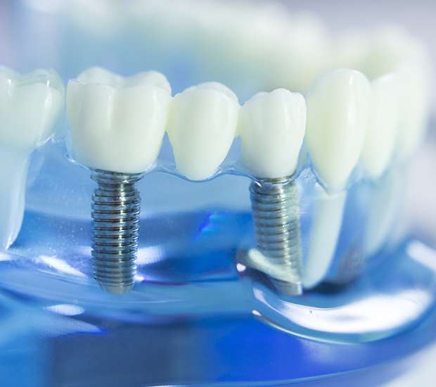 The Bronx Dental Implants