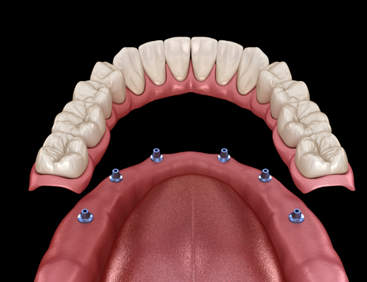 The Implant Supported Denture Process From Start To Finish